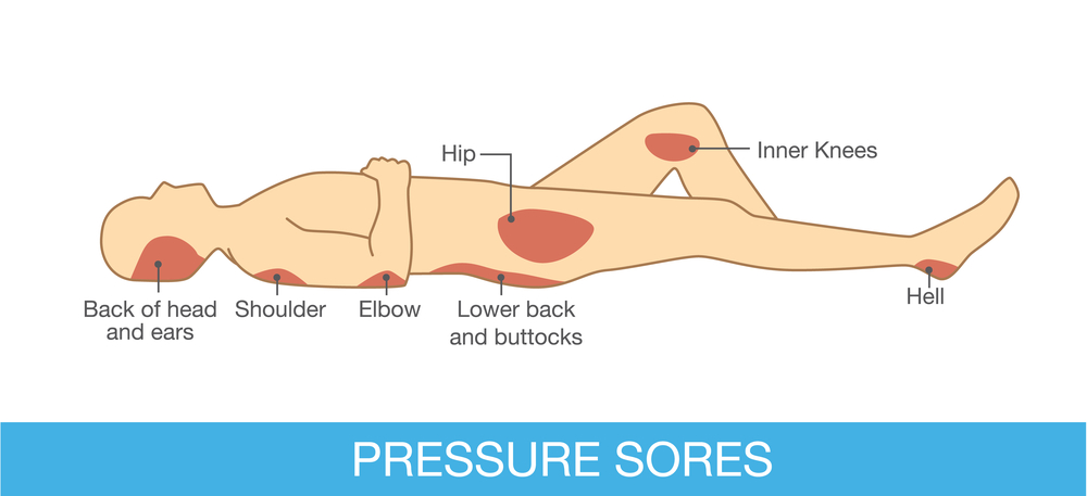 Illustration showing common areas for pressure sores